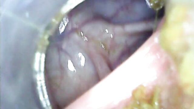 Deep deep anal again home colonoscopy Endoscope Part 1