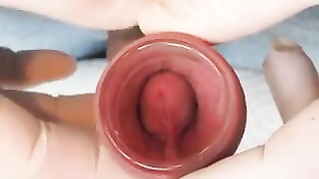 Glass tunnel in the foreskin.