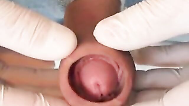 Glass tunnel in the foreskin.